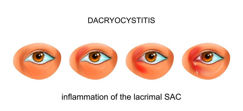 Tear duct infection (dacryocystitis)