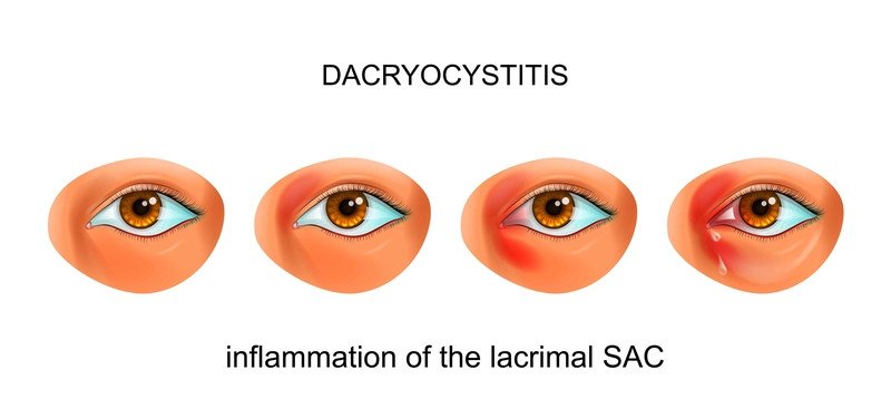 canal lacrimal Infecção (Dacryocystitis)