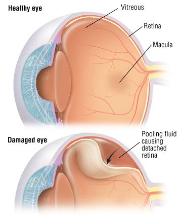 retinal detachment vision