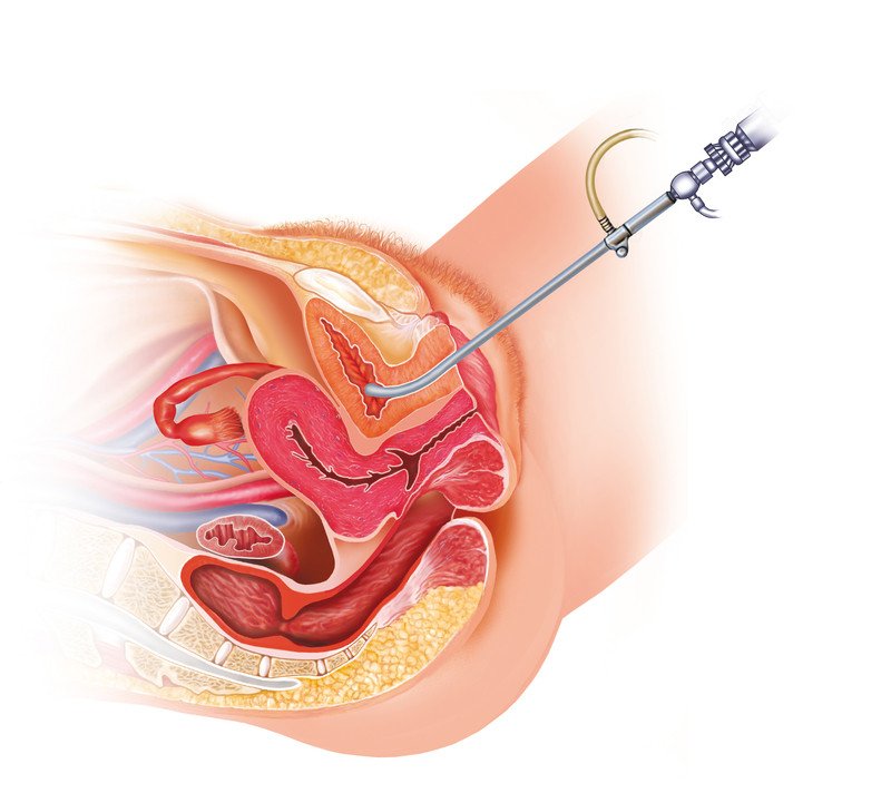 Hematuria