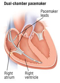 Bradycardia Causes Symptoms Treatment Options Drugs Com Bradycardia Causes Symptoms Treatment Options Drugs Com