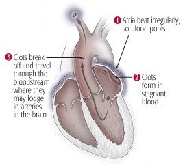 Atrial fibrillation