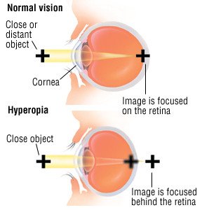 Farsightedness (Hyperopia)