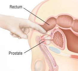 congestive prostatitis discharge)