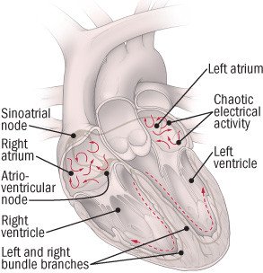 Cardiac arrhythmias