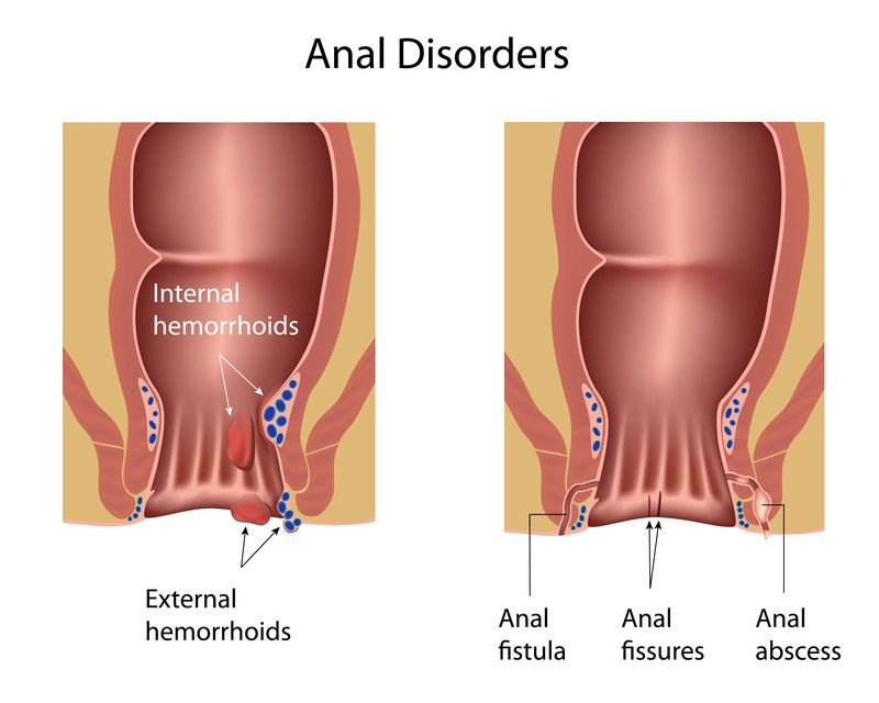 Anal Disorders Guide Causes, Symptoms and Treatment Options