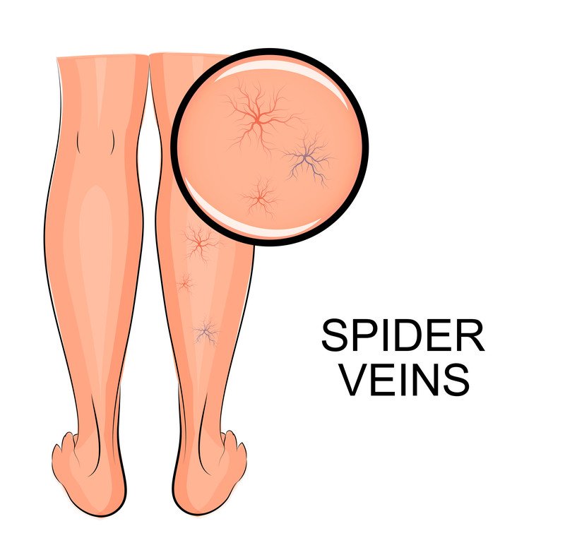 Spider veins