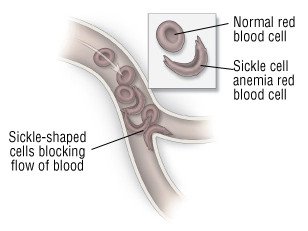 Sickle Cell Anemia