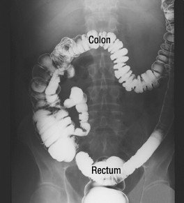 Barium enema