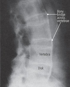 Ankylosing spondylitis