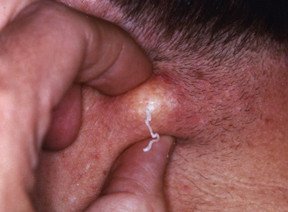 Sebaceous cysts