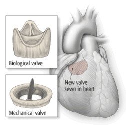 Heart valve replacement