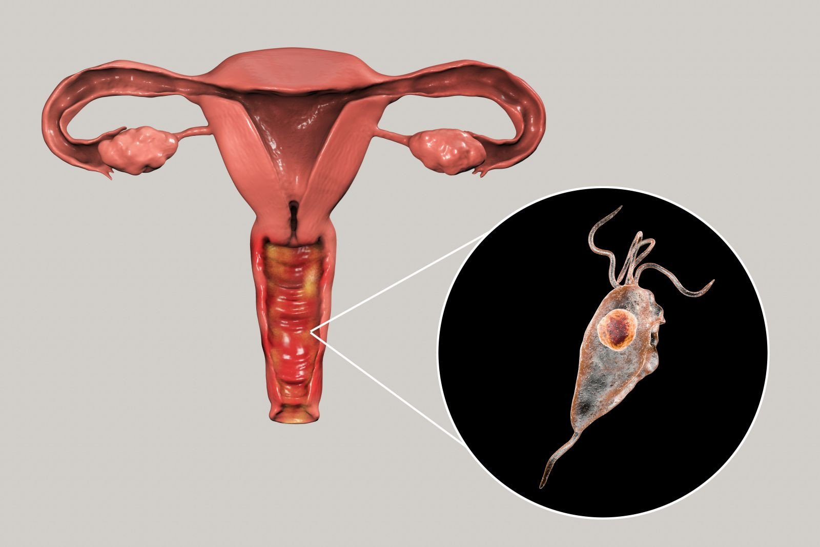 trichomonas colitis