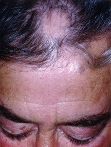 Alopecia areata