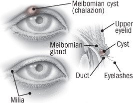 Blepharitis