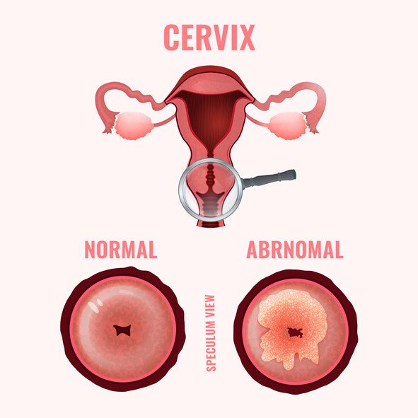 Pap Test (Papanicolaou Smear)