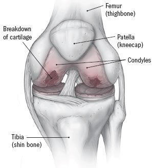 Osteoarthritis