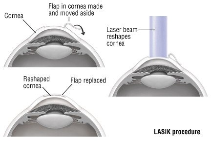 LASIK