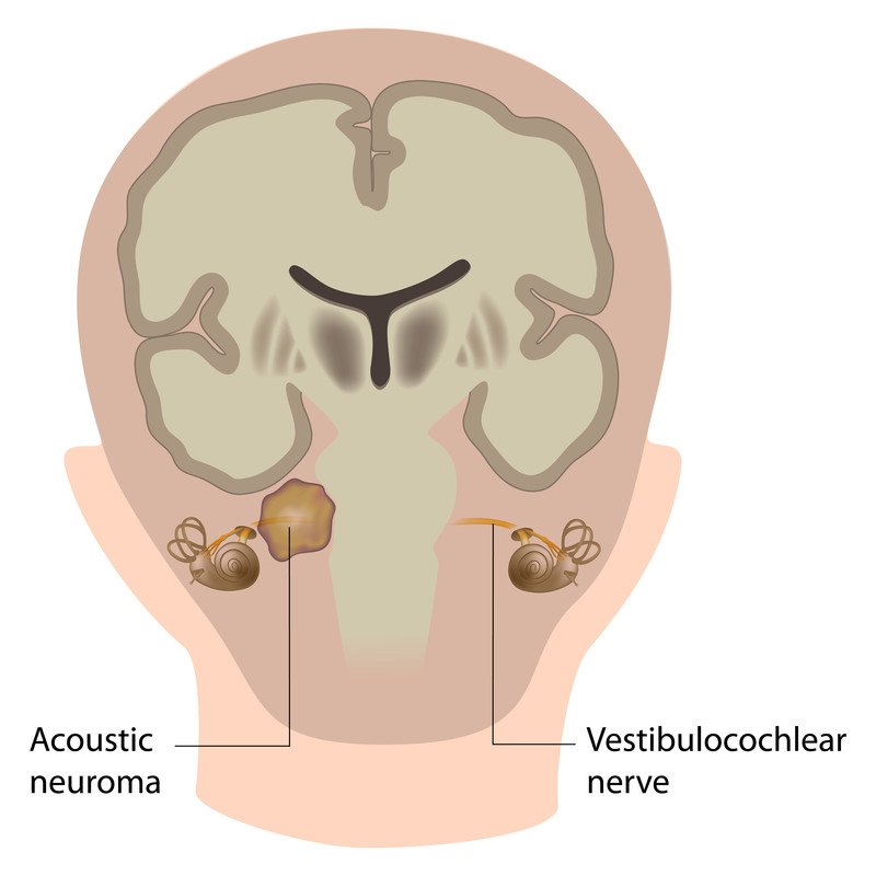 Acoustic Neuroma Guide Causes, Symptoms and Treatment Options