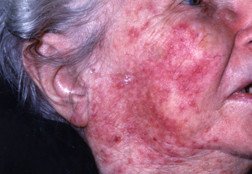 Rosacea