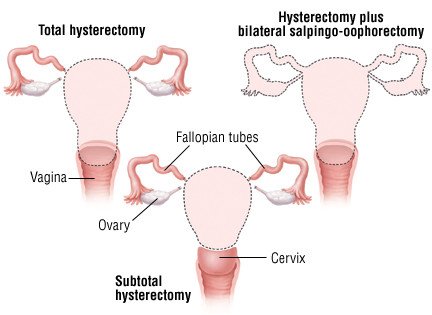 hysterectomy abdominal ovaries incision fallopian incisions uterus abdomen