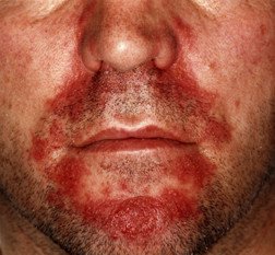 Seborrheic dermatitis