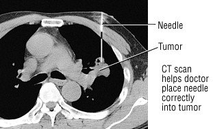 Lung cancer