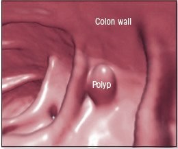 Colon polyps