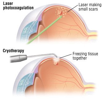 What is Retinal Detachment and How to Treat It