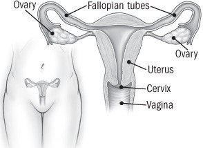 Cervical polyps