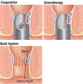 Anal Swelling - Causes and Treatment Options | Chennai Laser Gastro