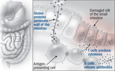 Celiac disease (non-tropical sprue)