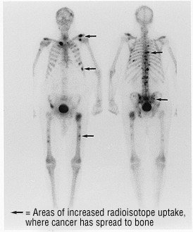Bone scan