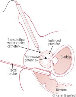 testosterone treatment and enlarged prostate