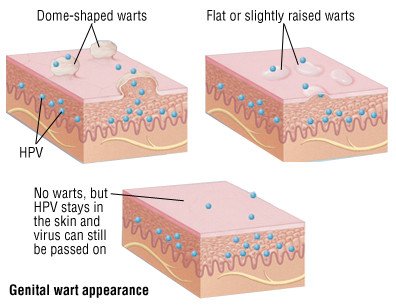 hpv wart signs