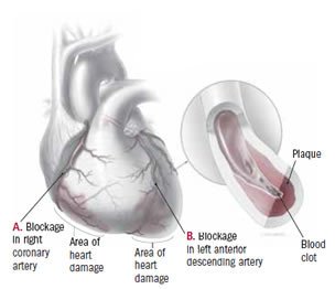 Heart attack (myocardial infarction)