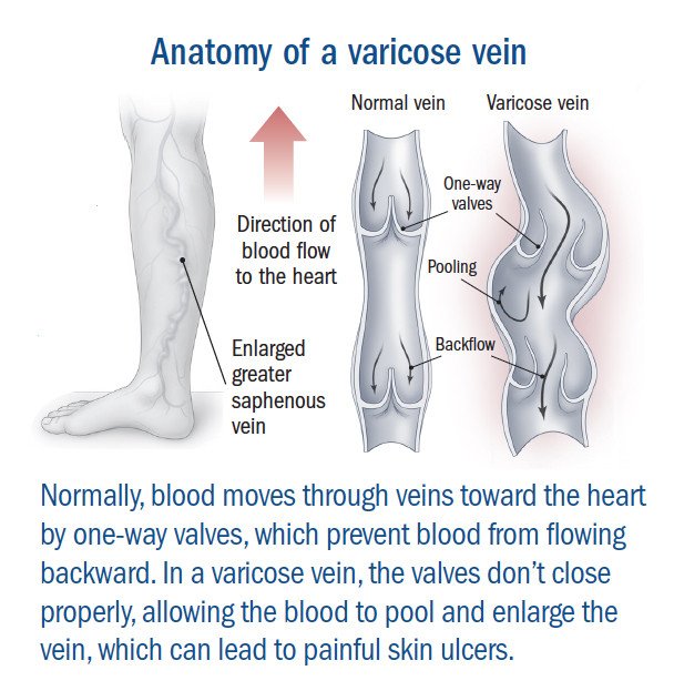 prevenii varicose ven)