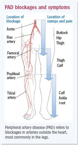 Peripheral arterial disease