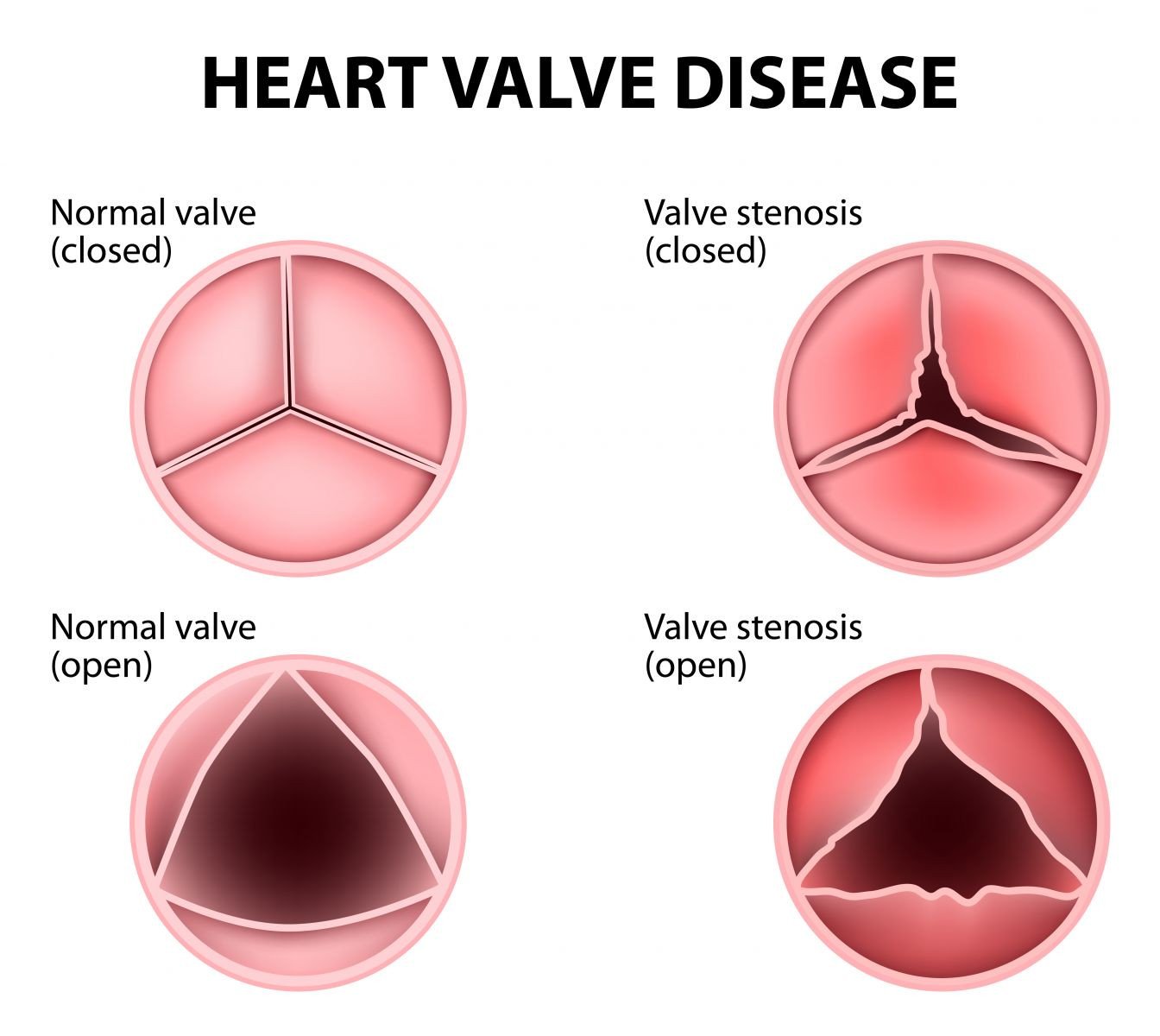 Heart Murmur