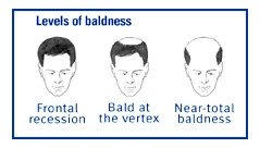Hereditary-Patterned Baldness Guide: Causes, Symptoms and Treatment Options
