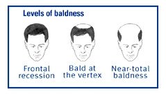 Hereditary-patterned baldness