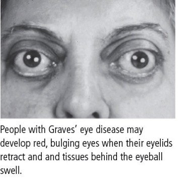 Graves' Eye Disease (Graves' Ophthalmopathy)