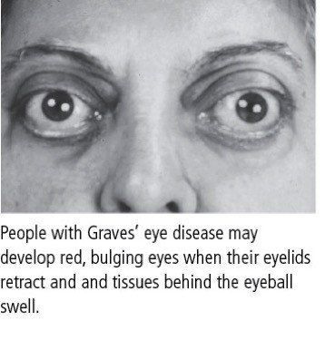 disease ophthalmopathy swelling pupil serious