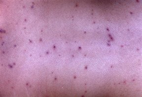 chicken pox pictures in adults