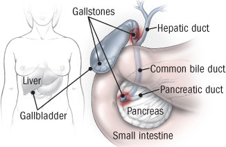 Bile duct diseases