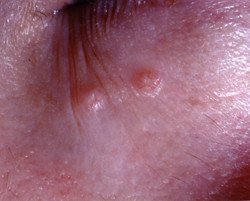 Molluscum Contagiosum Guide Causes Symptoms And Treatment Options