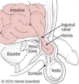 abdominal hernia in adults