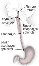 Esophagitis