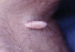 Skin tags (acrochordon)