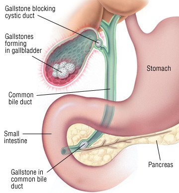 colicky stomach pain